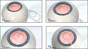 Lentes Trifocales
