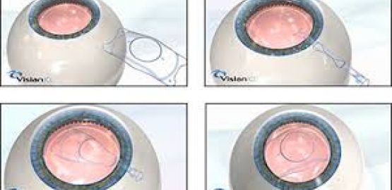 Lentes Trifocales