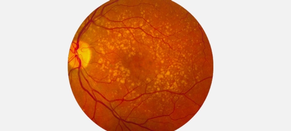 Degeneración macular