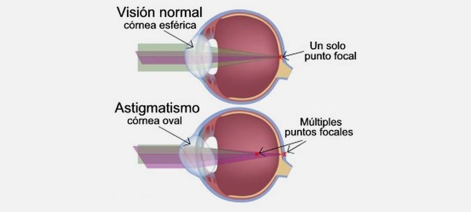 Astigmatismo