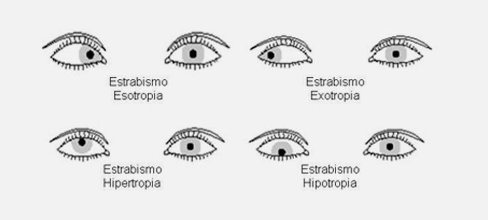 Estrabismo