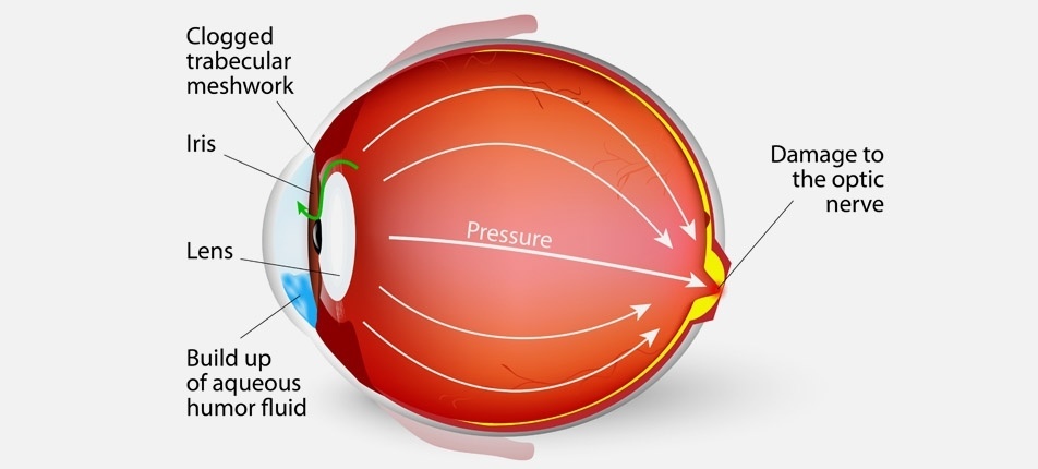 Glaucoma
